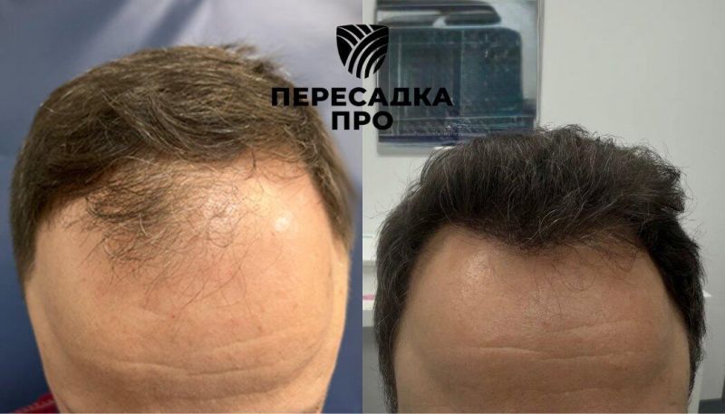 3 степень облысения, пересажено 3000 графтов, результат через 12 месяцев