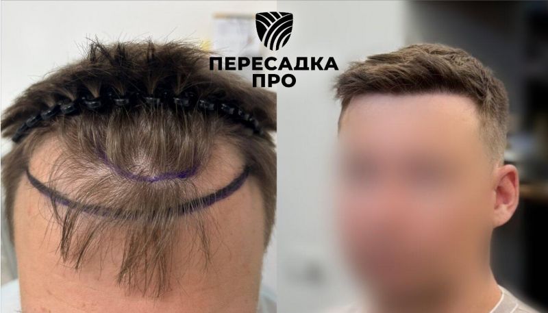 Отсутствует степень облысения, пересажено 2900 графтов, результат через 12 месяцев