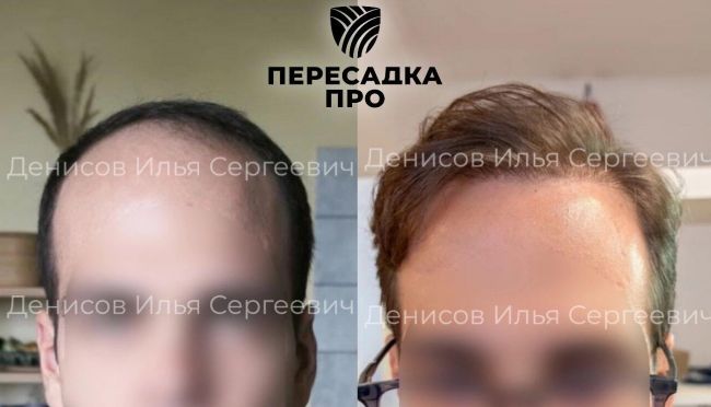 5 степень облысения, пересажено 3500 графтов, результат через 8 месяцев