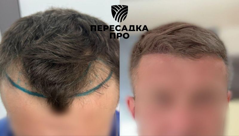 2 степень облысения, пересажено 2500 графтов, результат через 7 месяцев