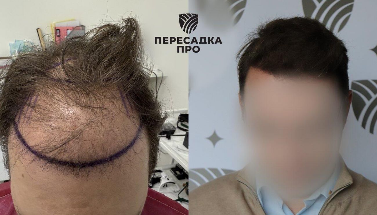 4 степень облысения, пересажено 4500 графтов, результат через 7 месяцев