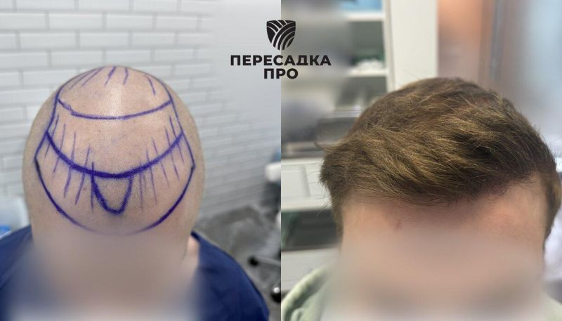 3 степень облысения, пересажено 4000 графтов, результат через 7 месяцев