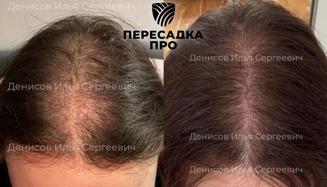 1–3 степень облысения по Людвигу, пересажено 2500 графтов, результат через 8 месяцев