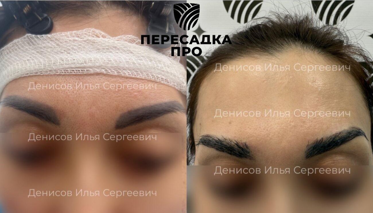 Эстетическая коррекция бровей, пересажено 600 графтов, результат через 7 месяцев