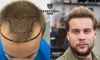 2–3 степень облысения, пересажено 3700 графтов, результат через 7 месяцев