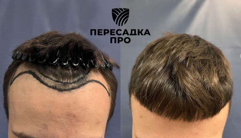 Отсутствует степень облысения, пересажено 1500 графтов, результат через 7 месяцев