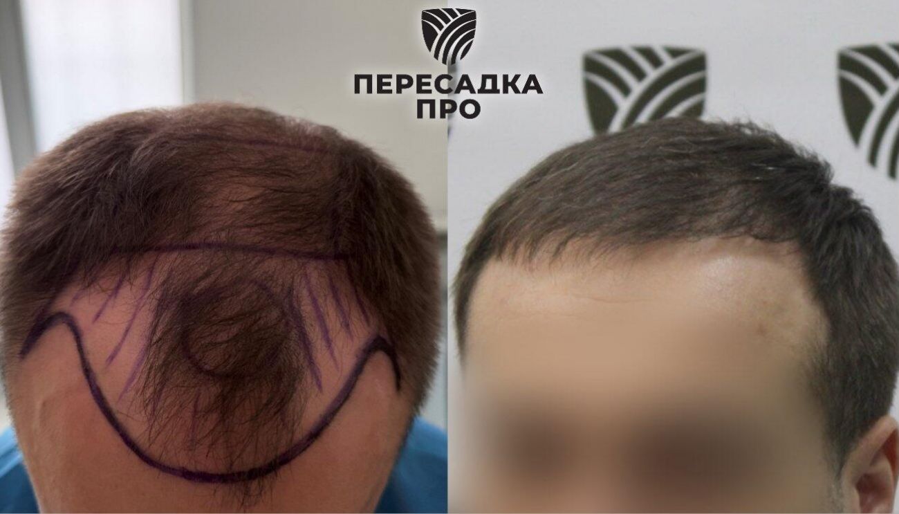 4-5 степень облысения, пересажено 5500 графтов, результат через 8 месяцев