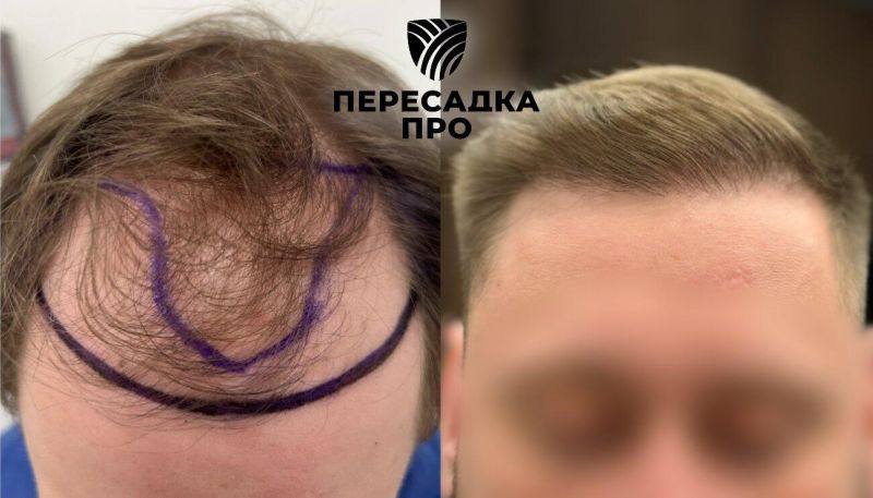 3–4 степень облысения, пересажено 3500 графтов, результат через 7 месяцев
