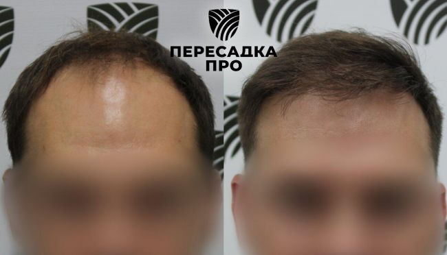 4–5 степень облысения, пересажено 6000 графтов, результат через 8 месяцев