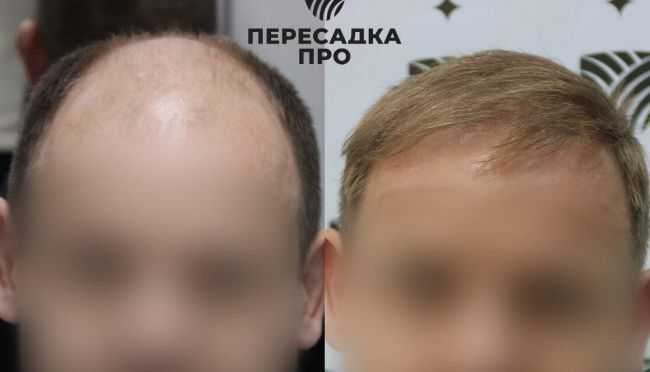 6 степень облысения, пересажено 6000 графтов, результат через 9 месяцев