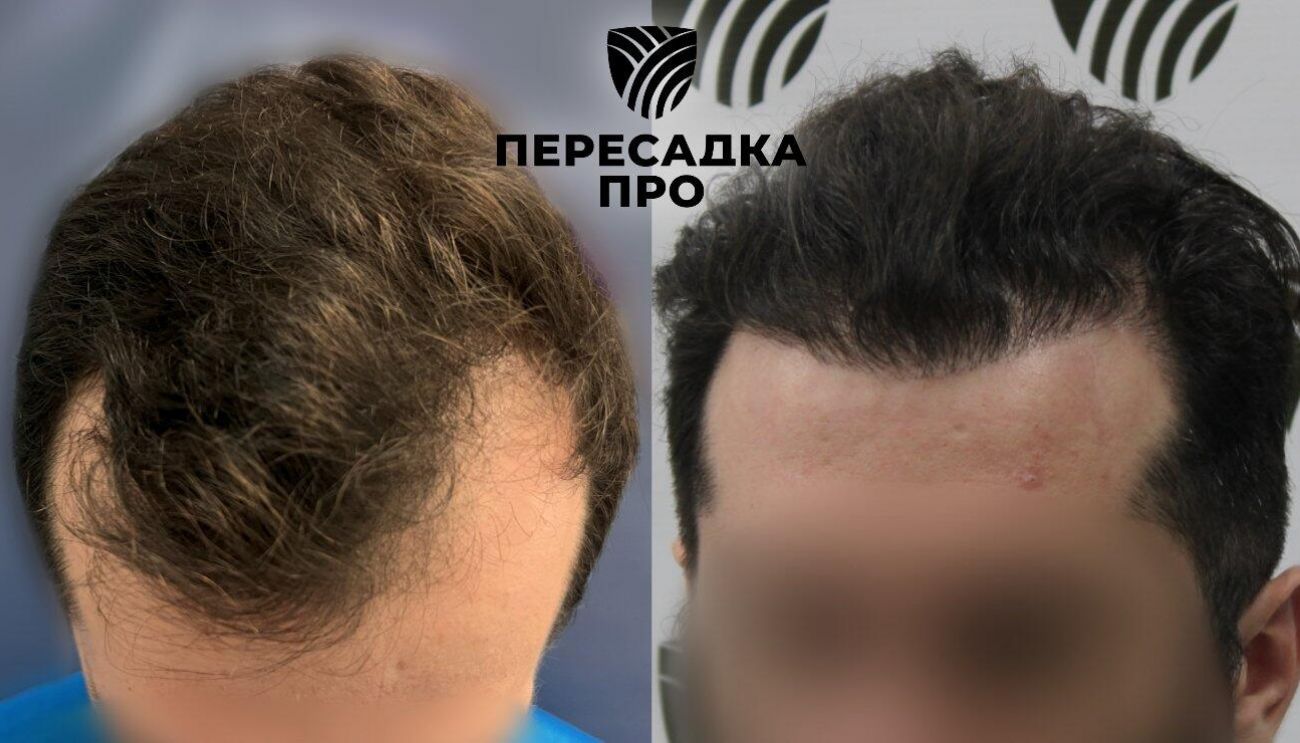 3 степень облысения, пересажено 3500 графтов, результат через 12 месяцев