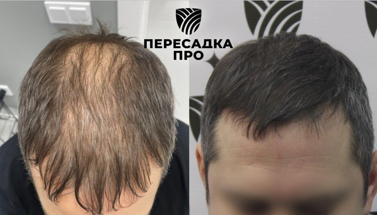 4 степень облысения, пересажено 4000 графтов, результат через 7 месяцев