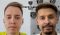 Отсутствует степень облысения, пересажено 3000 графтов, результат через 12 месяцев