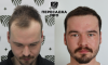 2–3 степень облысения, пересажено 3500 графтов, результат через 3 месяца