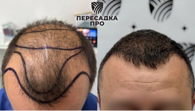 6 степень облысения, пересажено 5000 графтов, результат через 12 месяцев